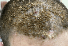 Acanthosis nigricans as scalp papillomatosis: acanthosis nigricans