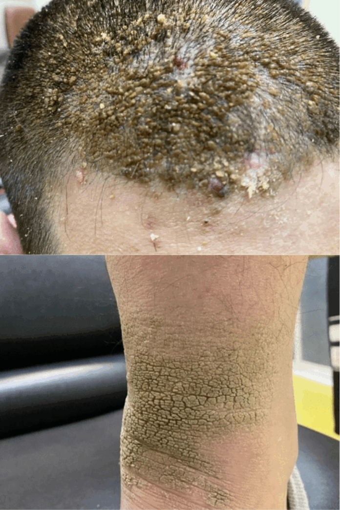 acanthosis nigricans