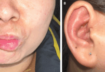 Ramsay Hunt Syndrome in a Previously Healthy 48-Year-Old Ramsay Hunt Syndrome