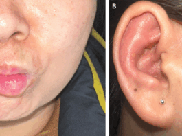 Ramsay Hunt Syndrome