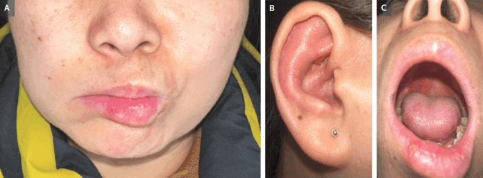 Ramsay Hunt Syndrome