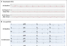 Smartwatch Saves Nurse from ‘Broken Heart’ Emergency Takotsubo Cardiomyopathy