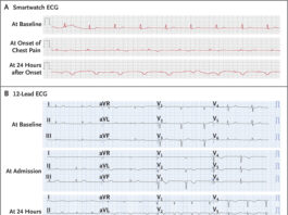 Takotsubo Cardiomyopathy