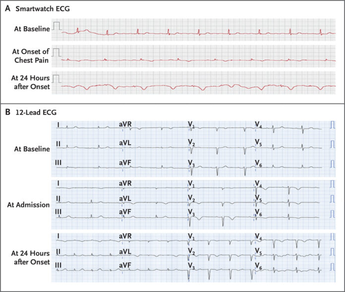 Takotsubo Cardiomyopathy
