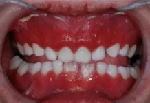 Keratitis–ichthyosis–deafness (KID) syndrome keratitis–ichthyosis–deafness