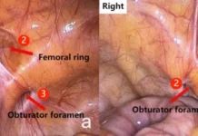 Incarcerated Obturator Hernia hernia