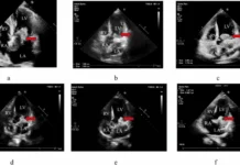 Cardiac Endosarcoma endosarcoma