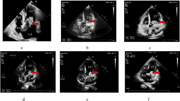 13256_2025_5538_Fig1_HTML endosarcoma