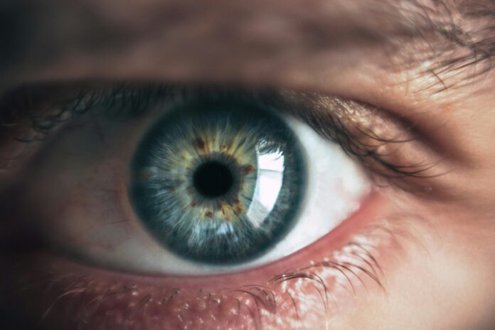 cataract