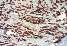 Axillary tumor deposits in primary breast carcinoma breast