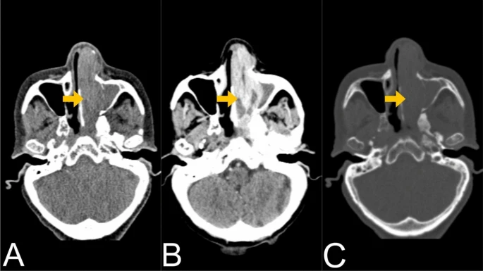 13256_2025_5544_Fig1_HTML mucosal melanoma