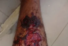 Pyoderma Gangrenosum pyoderma gangrenosum