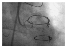 Acute Coronary Syndrome Acute Coronary Syndrome