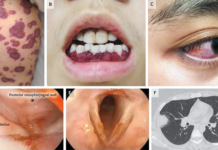 Granulomatosis with Polyangiitis
