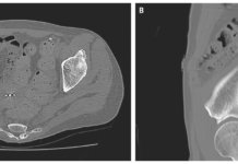 Myositis Ossificans Myositis Ossificans