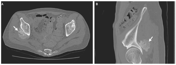 Myositis Ossificans