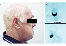 Isolated Mandibular Enlargement in an Adult Male Isolated Mandibular Enlargement