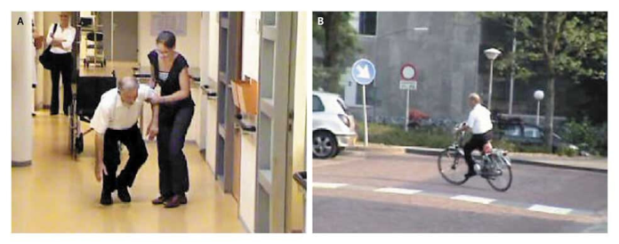 Paradoxical Kinesia in Parkinson’s Disease: Preserved Cycling Despite Severe Freezing of Gait