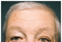 Unilateral Nodular Elastosis with Comedones Unilateral Dermatoheliosis