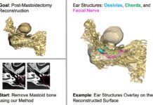 Imaging technology that Aid Bone Removal in Cochlear implant cochlea