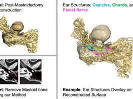 Imaging technology that Aid Bone Removal in Cochlear implant cochlea