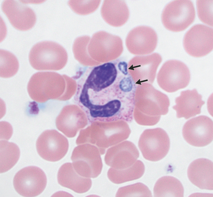 Anaplasmosis