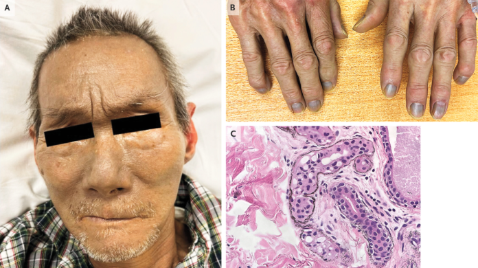Argyria Argyria