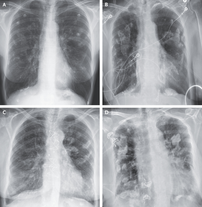 Pleural plaques because of asbestos exposure