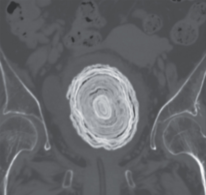 Bladder stones Bladder stones