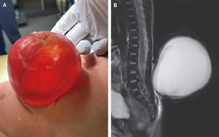 Congenital Spinal Meningocele