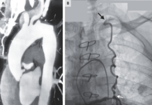 Coronary Subclavian Steal Syndrome Coronary Subclavian Steal Syndrome