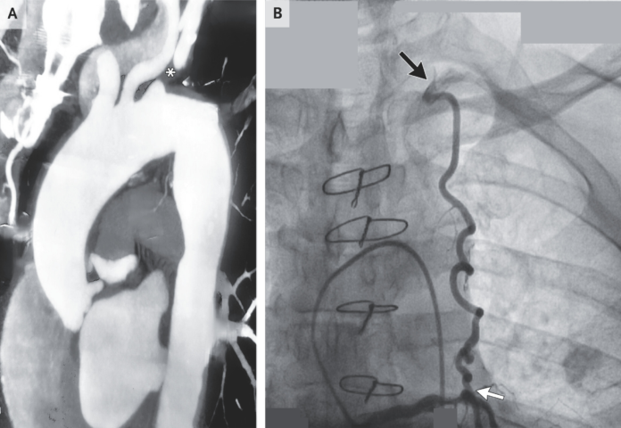 Coronary Subclavian Steal Syndrome Coronary Subclavian Steal Syndrome