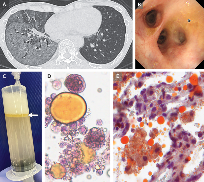 Exogneous lipoid pneumonia Exogneous Lipoid Pneumonia