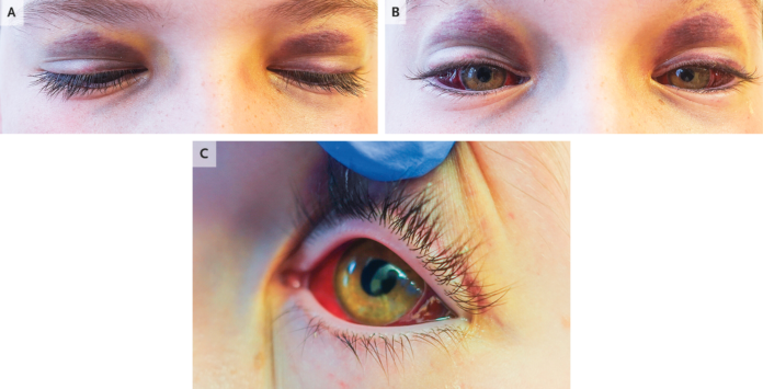 Eyelid Ecchymosis