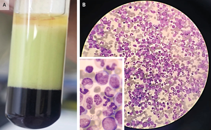 Myeloid Leukemia