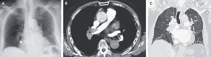 Pulmonary Embolism