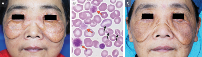 Sitosterolemia