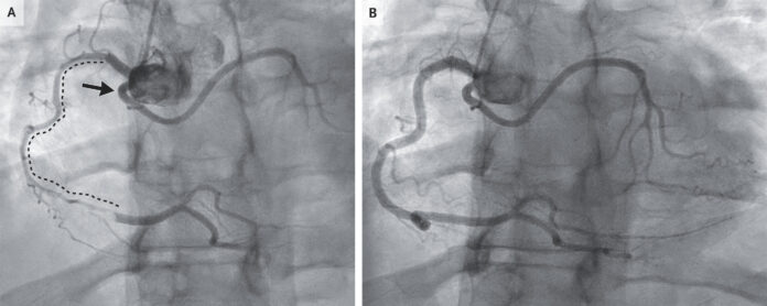 nejmicm2407274_f1 Spontaneous Coronary-Artery Dissection