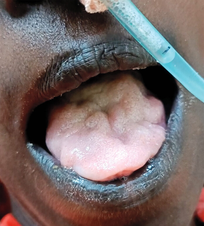 Tongue Atrophy and Fasiculations
