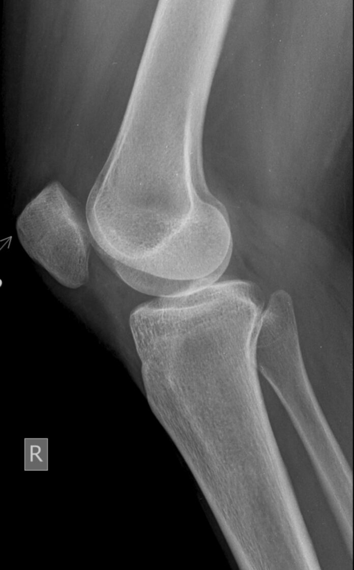 pexels-gayan-kavinda-2157879009-35054137 knee