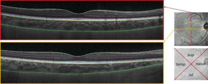 myopia