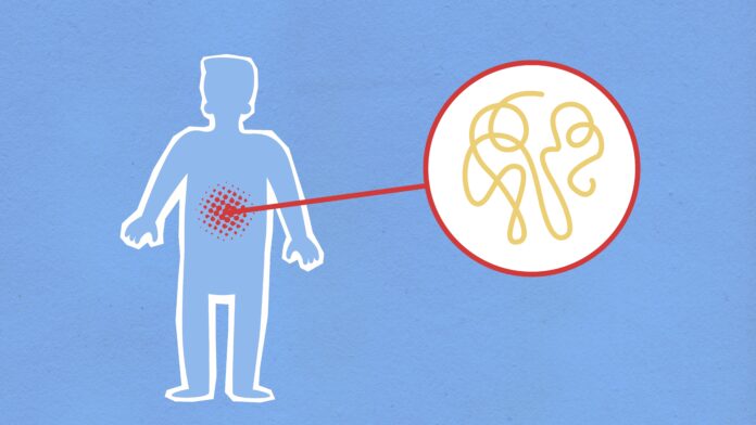 sepsis